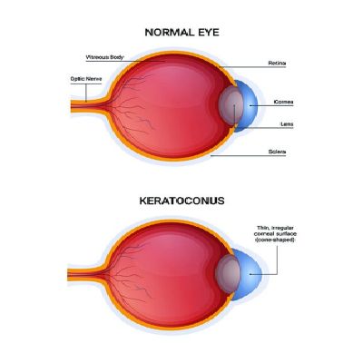 Doctor performing cataract examination